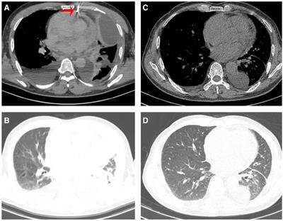 Case Report: Two cases of advanced primary cardiac angiosarcoma treated with anlotinib and a retrospective analysis of the literature